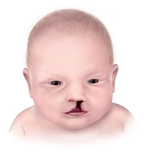 Crouzon syndrome: MedlinePlus Genetics.